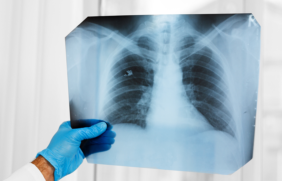LUNG CENTER